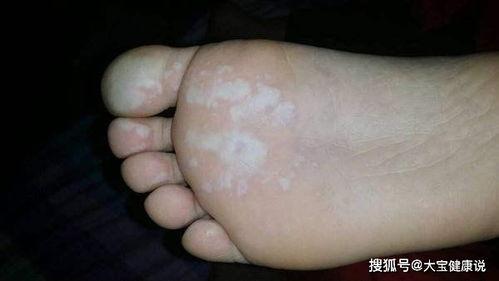 国产脚底角质去除视频,国产去角质视频教程大揭秘